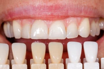 Porcelain Veneers